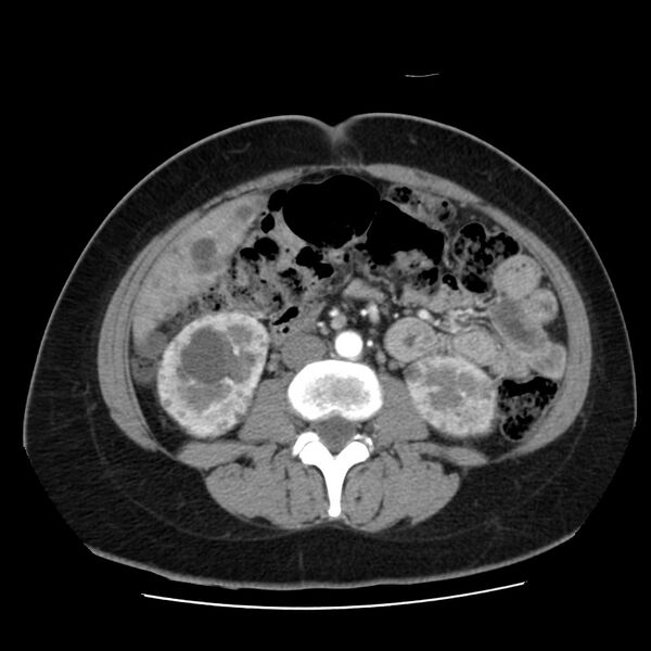 File:Autosomal dominant polycystic kidney disease (Radiopaedia 23061-23093 B 37).jpg