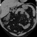 Autosomal dominant polycystic kidney disease (Radiopaedia 36539-38101 Coronal non-contrast 5).jpg
