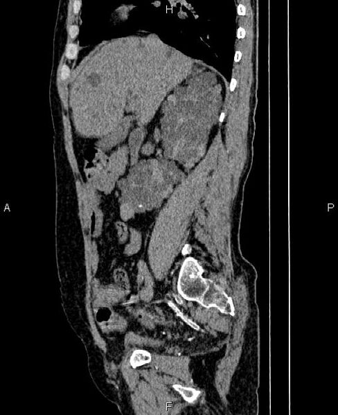 File:Autosomal dominant polycystic kidney disease (Radiopaedia 87830-104287 C 31).jpg
