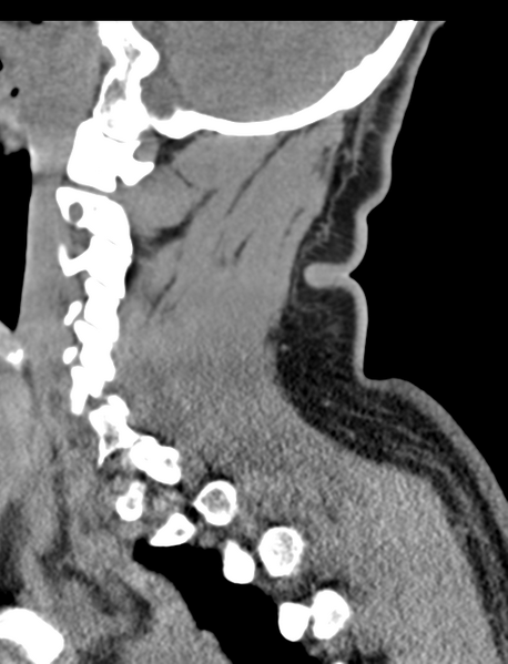 File:Axis peg fracture (type 3) and atlas lateral mass (type 4) fracture (Radiopaedia 37474-39324 D 24).png