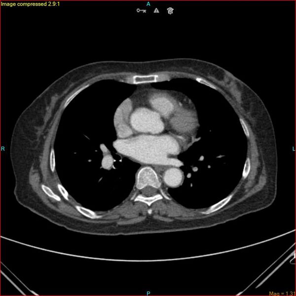 File:Azygos vein aneurysm (Radiopaedia 77824-90130 B 33).jpg