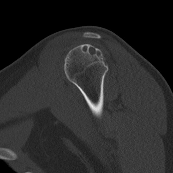 File:Bankart lesion (Radiopaedia 22771-22798 Sagittal bone window 14).jpg