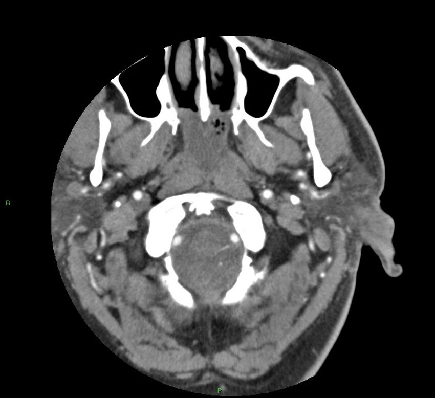 Basal ganglia hemorrhage (Radiopaedia 58763-65985 D 12).jpg