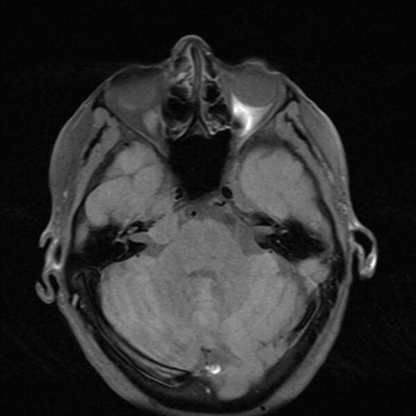 File:Base of skull chondrosarcoma (Radiopaedia 30410-31070 Axial T1 fat sat 10).jpg