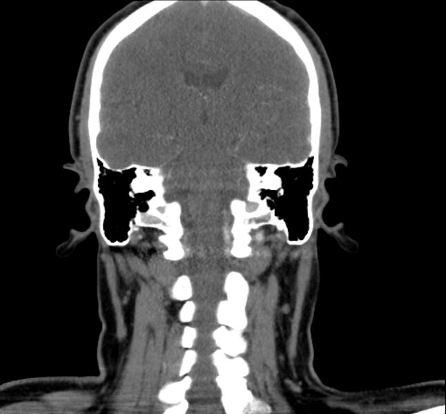 File:Benign mixed salivary tumor of the parotid gland (Radiopaedia 35261-36792 B 23).jpg