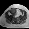Benign seromucinous cystadenoma of the ovary (Radiopaedia 71065-81300 Axial T1 14).jpg
