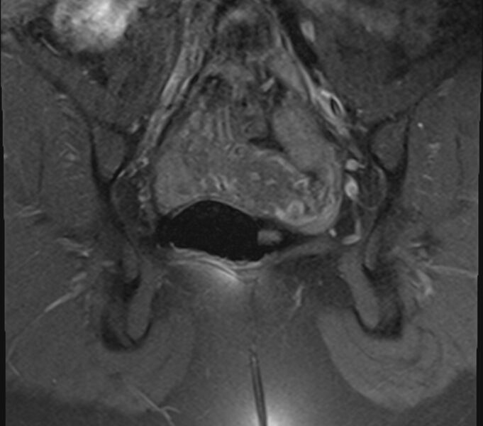 File:Bicornuate uterus (Radiopaedia 71214-81511 Coronal T1 fat sat 12).jpg