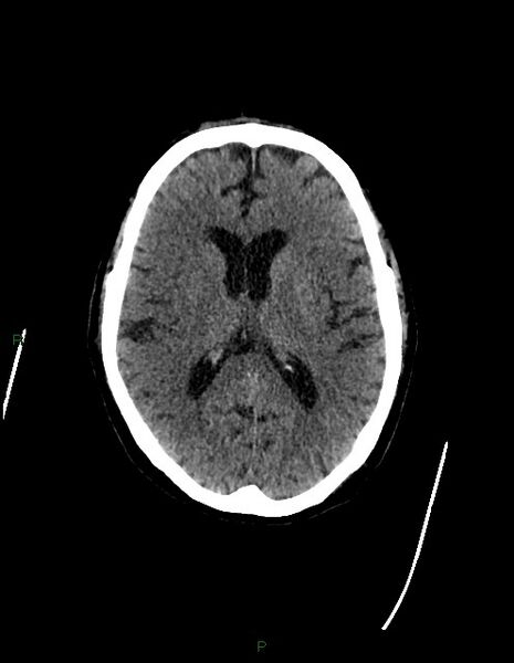 File:Bilateral acute middle cerebral artery territory infarcts (Radiopaedia 77319-89401 Axial non-contrast 48).jpg