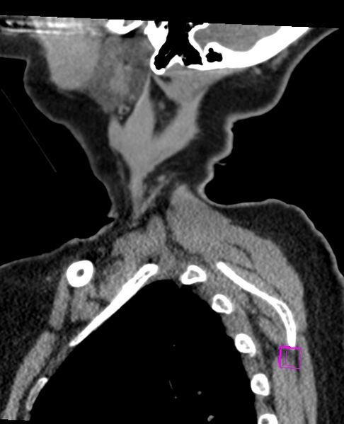 File:Bilateral atlanto-occipital assimilation (Radiopaedia 28350-28603 D 5).jpg