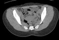 Bilateral mature cystic ovarian teratoma (Radiopaedia 88821-105592 Axial non-contrast 13).jpg