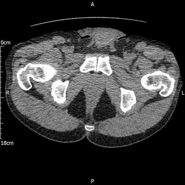 File:Bilateral medullary nephrocalcinosis with ureteric calculi (Radiopaedia 71269-81569 Axial non-contrast 136).jpg