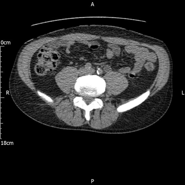 File:Bilateral medullary nephrocalcinosis with ureteric calculi (Radiopaedia 71269-81569 Axial non-contrast 81).jpg