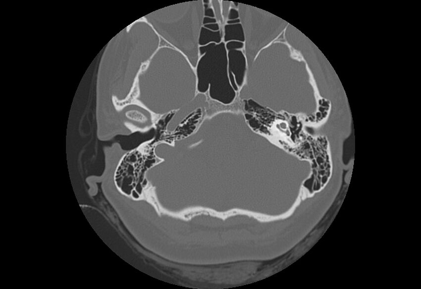 Bilateral otospongiosis (Radiopaedia 35447-36940 B 22).jpg