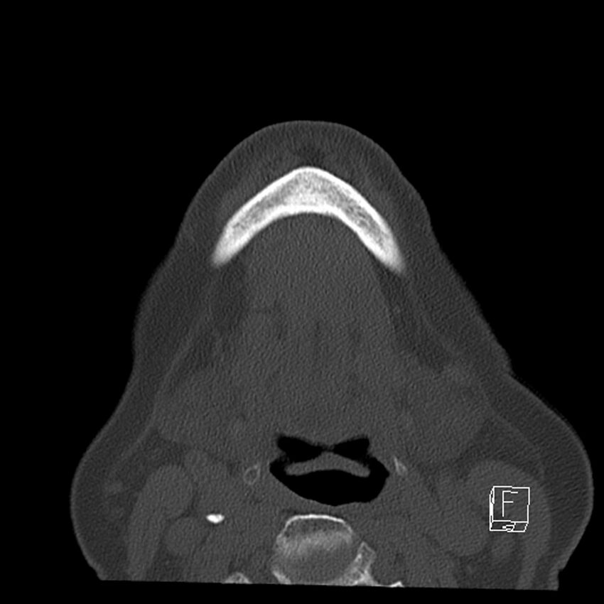 Bilateral palatine tonsilloliths on OPG and CT (Radiopaedia 75167-86247 Axial bone window 57).jpg