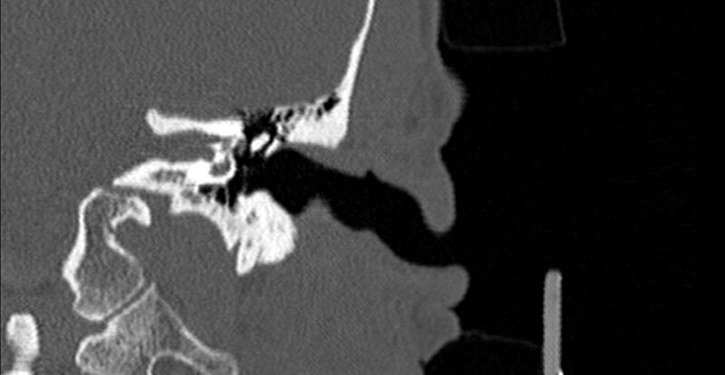 File:Bilateral temporal bone fractures (Radiopaedia 29482-29970 B 29).jpg