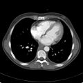 Biliary necrosis - liver transplant (Radiopaedia 21876-21846 A 1).jpg
