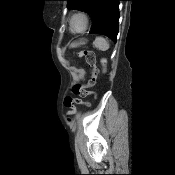 File:Bladder tumor detected on trauma CT (Radiopaedia 51809-57609 E 14).jpg