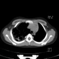 Bochdalek diaphragmatic hernia (Radiopaedia 38866-41059 A 6).jpg