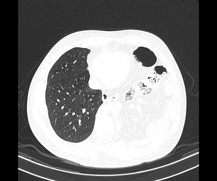 Bochdalek hernia - adult presentation (Radiopaedia 74897-85925 Axial lung window 33).jpg