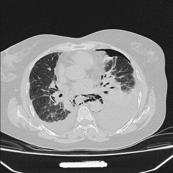 File:Boerhaave syndrome (Radiopaedia 45644-49799 Axial lung window 67).jpg