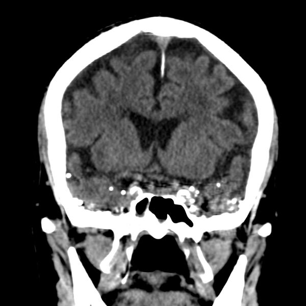 File:Brain Pantopaque remnants (Radiopaedia 78403-91048 Coronal non-contrast 29).jpg