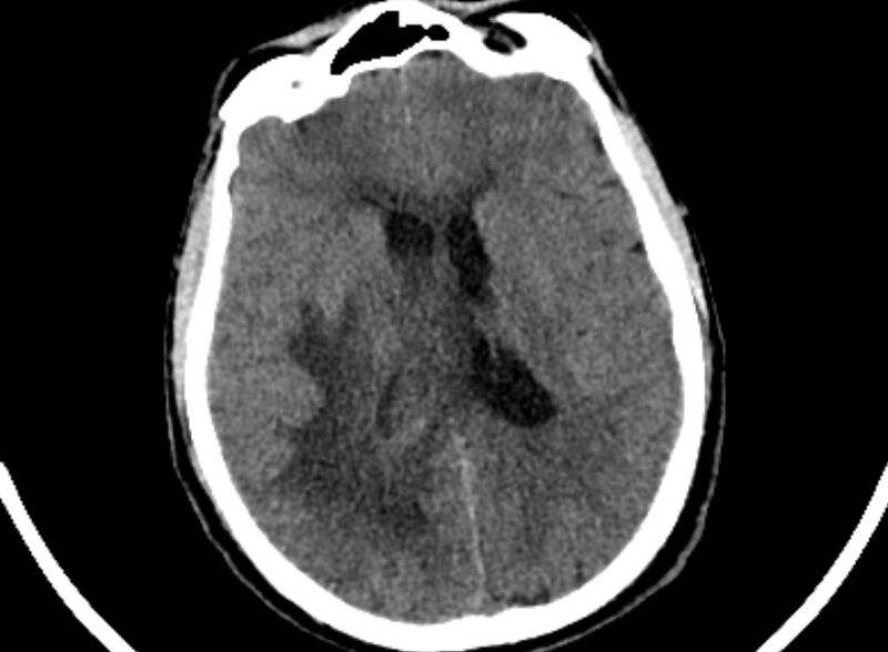 File:Brain abscess complicated by intraventricular rupture and ventriculitis (Radiopaedia 82434-96575 Axial non-contrast 55).jpg