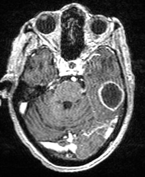 File:Brain abscess with dual rim sign (Radiopaedia 87566-103938 Axial T1 C+ 55).jpg