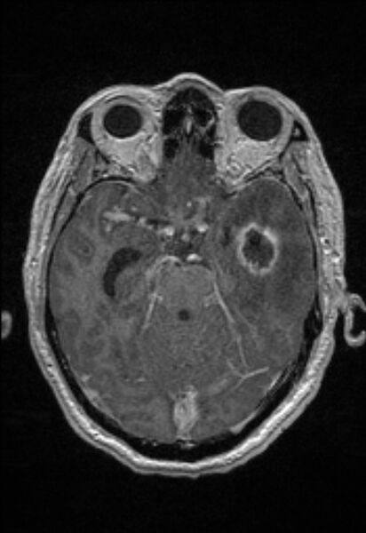 File:Brain abscess with ventriculitis (Radiopaedia 85703-101495 Axial T1 C+ 68).jpg