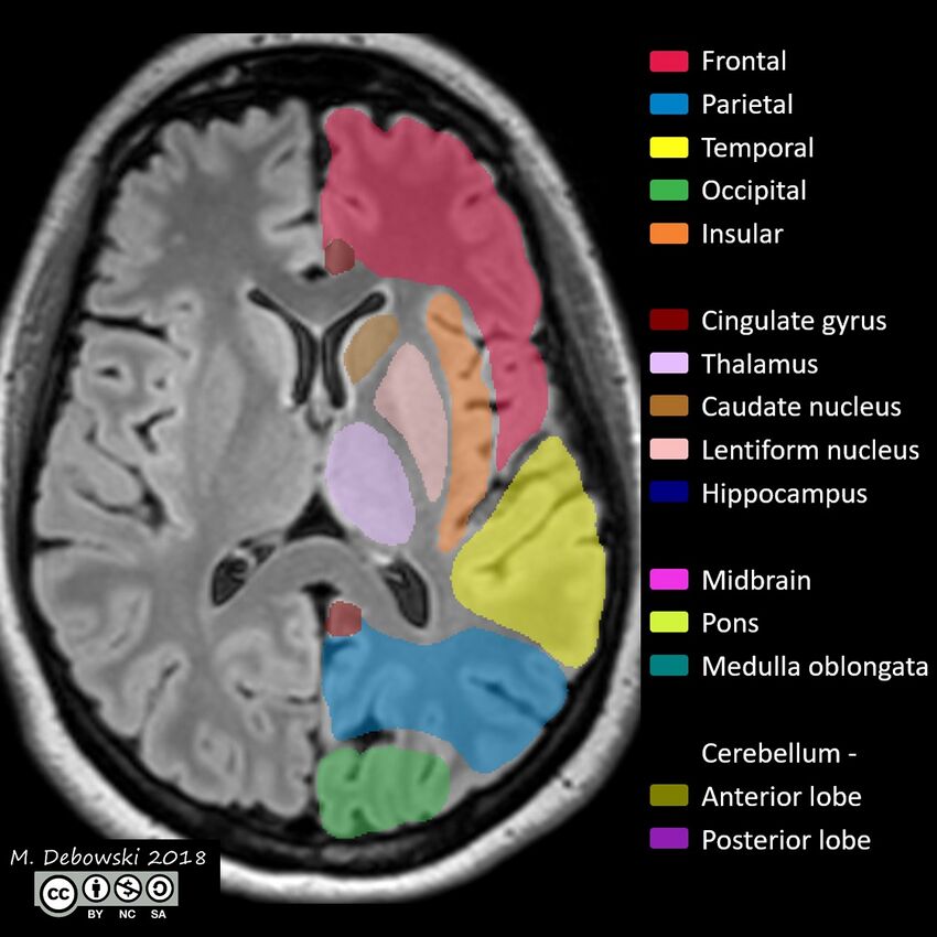 Brain lobes - annotated MRI (Radiopaedia 61691-69700 Axial 34).JPG