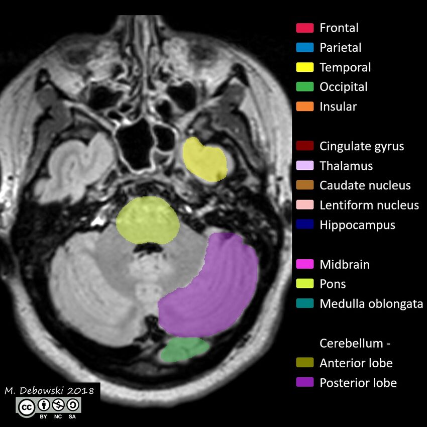 Brain lobes - annotated MRI (Radiopaedia 61691-69700 Axial 60).JPG