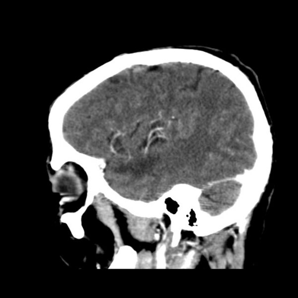 File:Brain metastases from lung cancer (Radiopaedia 24480-24781 C+ delayed 45).jpg