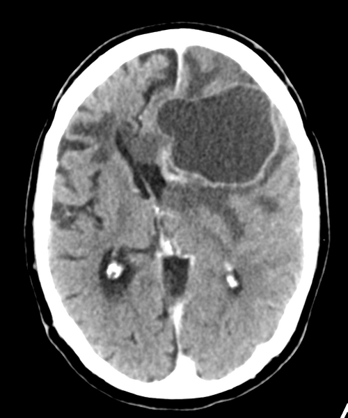 File:Brain metastasis (lung cancer) (Radiopaedia 48289-53177 Axial C+ 16).png