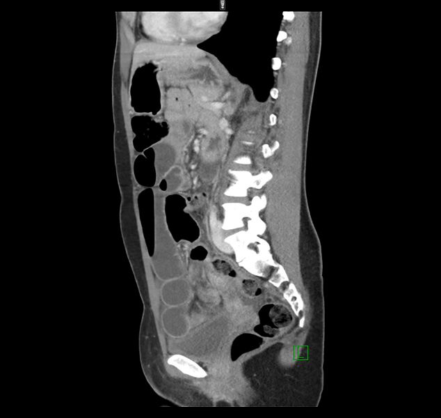 File:Broad ligament hernia (Radiopaedia 63260-71832 C 31).jpg