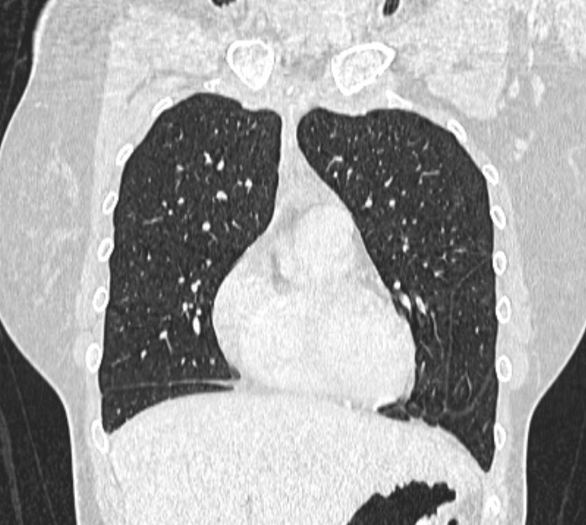 Bronchial atresia (Radiopaedia 50007-55297 Coronal lung window 26).jpg
