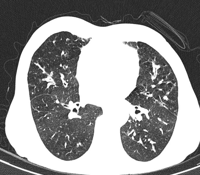 File:Bronchiolitis (Radiopaedia 24616-24887 Axial lung window 32).jpg