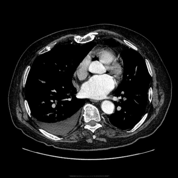 File:Bronchogenic adenocarcinoma and pulmonary embolism (Radiopaedia 9097-9806 D 38).jpg