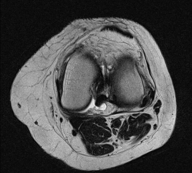 File:Bucket handle tear - medial meniscus (Radiopaedia 79028-91942 Axial T2 12).jpg