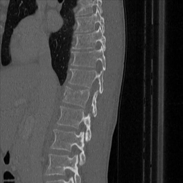 File:Bulging of paraspinal line in traumatic thoracal spinal compression fracture (Radiopaedia 29221-35872 Sagittal bone window 14).jpg
