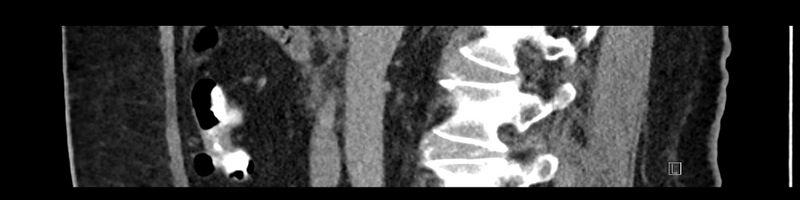 File:Buried bumper syndrome - gastrostomy tube (Radiopaedia 63843-72575 Sagittal Inject 72).jpg