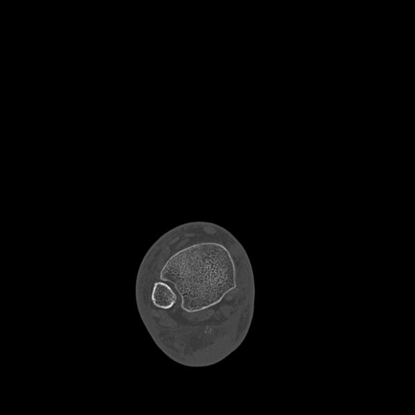 File:Calcaneal tuberosity avulsion fracture (Radiopaedia 22649-22668 Axial bone window 3).jpg