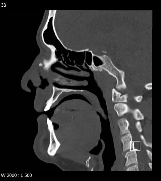 File:Calcification of the transverse band of the cruciform ligament (Radiopaedia 53063-59025 Sagittal bone window 10).jpg