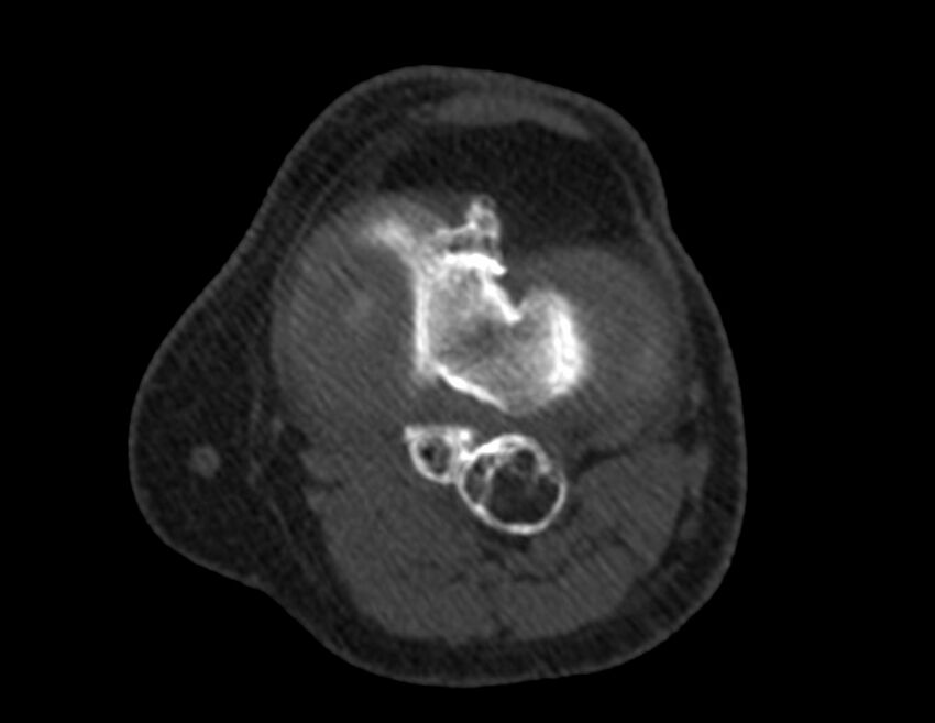 Calcified hematoma - popliteal fossa (Radiopaedia 63938-72763 Axial bone window 28).jpg