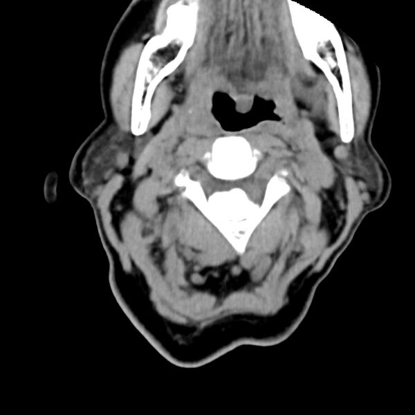 File:Calcified meningioma - cervical canal (Radiopaedia 70136-80171 B 10).jpg