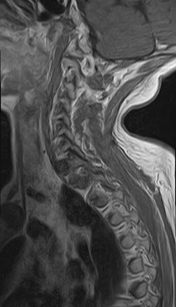 File:Calcified meningioma - cervical canal (Radiopaedia 70136-82468 Sagittal 4).jpg