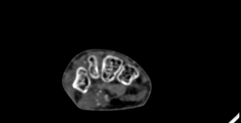 File:Calcifying aponeurotic fibroma (Radiopaedia 88423-105064 B 100).jpg