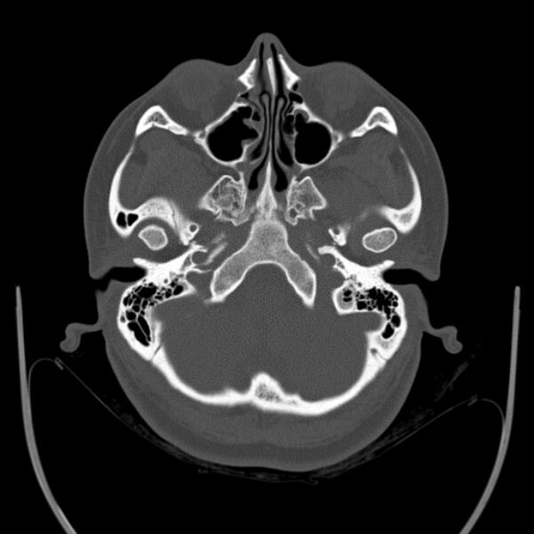 File:Calvarial osteoma (Radiopaedia 36520-38079 Axial bone window 19).jpg