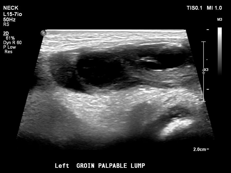 File:Canal of Nuck hernia containing ovary (Radiopaedia 77253).jpg