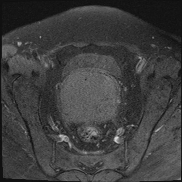 File:Cancer cervix - stage IIb (Radiopaedia 75411-86615 T1 fat sat 18).jpg