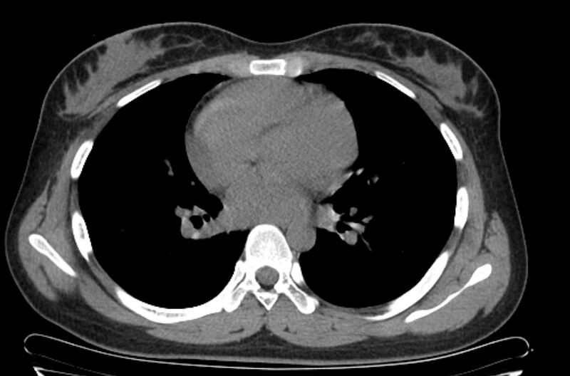 File:Cannonball metastases - uterine choriocarcinoma (Radiopaedia 70137-80173 Axial non-contrast 64).jpg