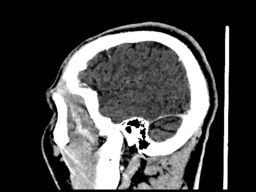 Capillary hemangioma of the orbit (Radiopaedia 44610-48358 C 114).jpg